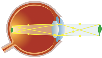Laser Eye Surgery Santa Monica
