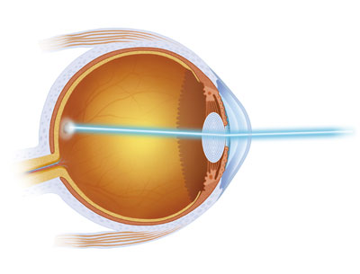 What Is Glaucoma Los Angeles
