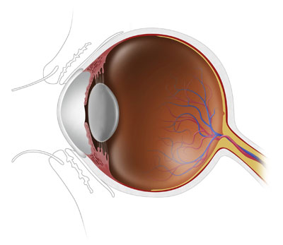 Cataract Surgery Santa Monica